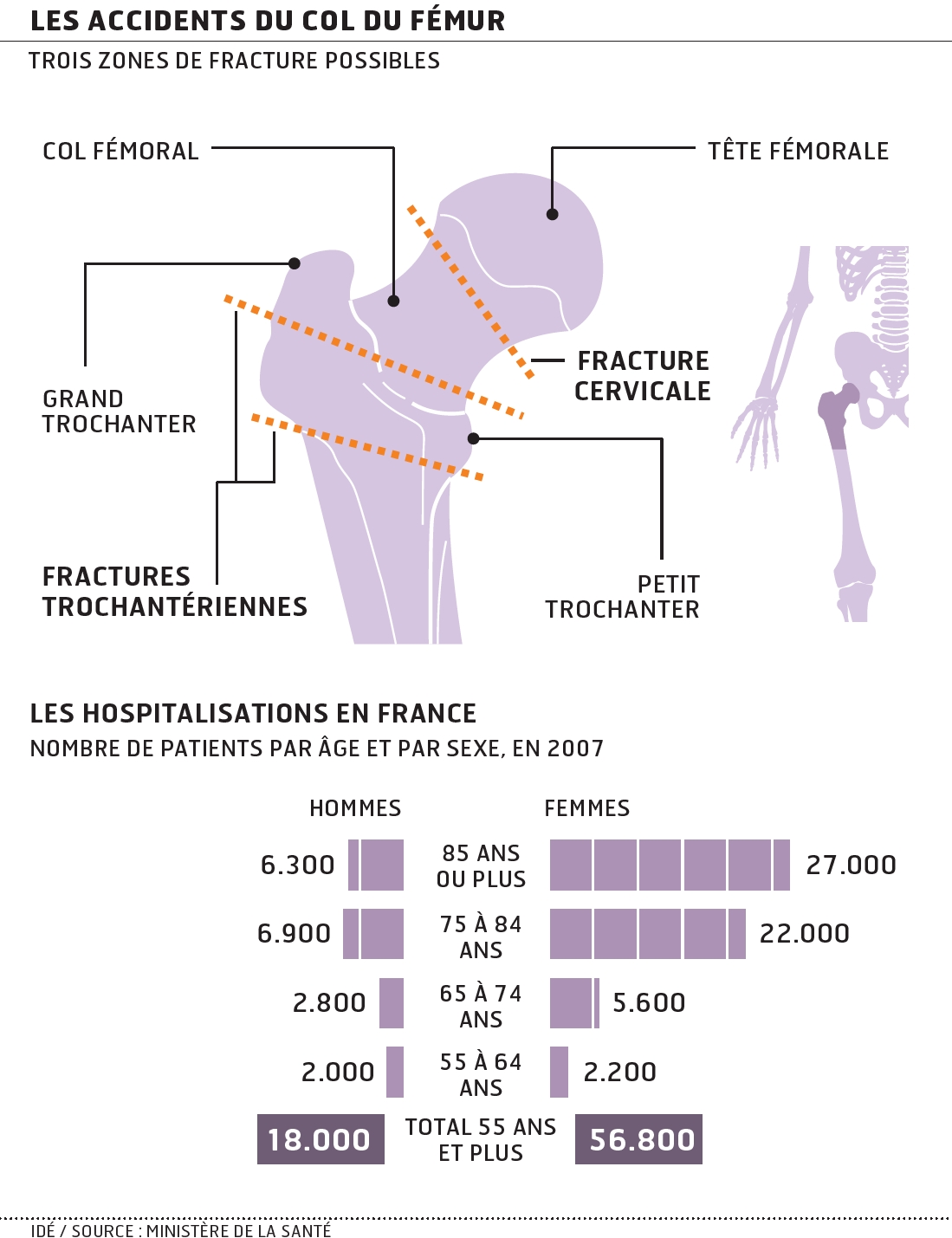 Pourquoi Meurt On D Une Fracture Du Col Du Fémur Mieux prendre en charge la fracture du col du fémur